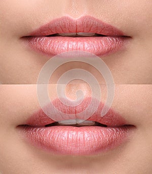 plump lips after filler injection