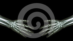 Shake hands . X-ray normal human hands ( blank area at upper side )
