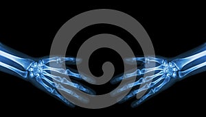 Shake hands . X-ray normal human hands ( blank area at upper side )
