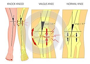 Shapes of the legs.Normal and curved legs.Knock knees.Bowed leg