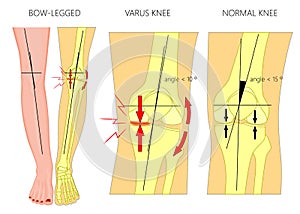 Shapes of the legs.Normal and curved legs.Knock knees.Bowed leg