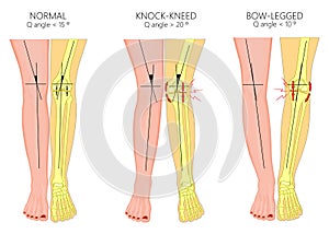 Shapes of the legs.Normal and curved legs.Knock knees.Bowed leg