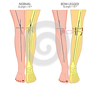 Shapes of the legs.Normal and curved legs.Knock knees.Bowed leg