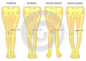 Shapes of the legs. Normal and curved legs. Knock knees. Bowed leg