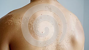 shed skin from sunburn