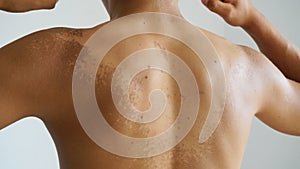 shed skin from sunburn