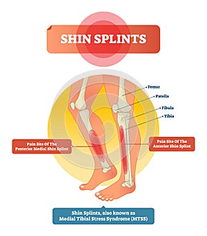 Shin splints vector illustration. Leg muscle sport trauma and bone pain.