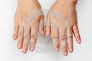 Shingles that causes a swollen hand photo