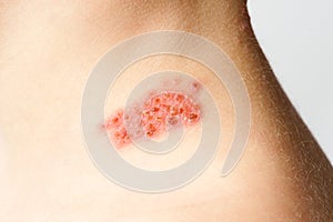 Shingles on child herpes zoster photo