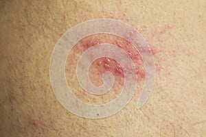 Shingles (herpes zoster) blister skin rash photo
