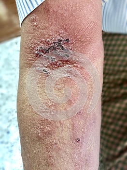 Shingles or herpes zoster infection in left arm of Southeast Asian adult man.