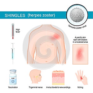 Shingles. infographics about symptoms of herpes zoster
