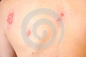 Shingles on men herpes zoster. Closeup. photo