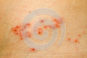 Shingles Rash