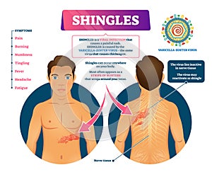 Shingles vector illustration. Labeled medical skin virus explanation scheme