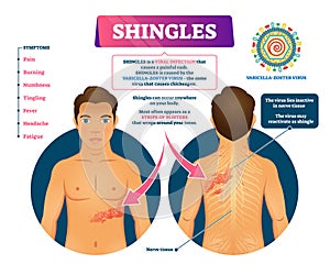 Shingles vector illustration. Labeled medical skin virus explanation scheme photo