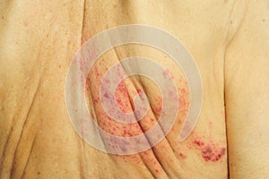 Shingles is a viral infection that causes a painful rash