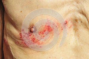 Shingles is a viral infection that causes a painful rash photo