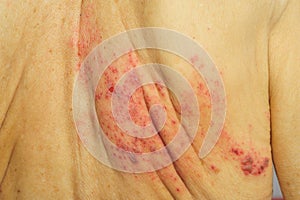 Shingles is a viral infection that causes a painful rash photo