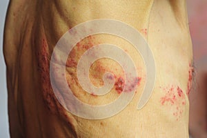 Shingles is a viral infection that causes a painful rash photo