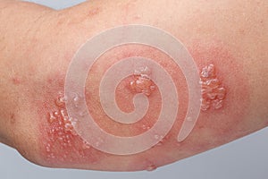 Shingles, Zoster or Herpes Zoster symptoms on arm photo