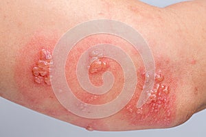 Shingles, Zoster or Herpes Zoster symptoms on arm