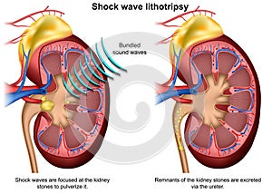 Shock wave lithotripsy 3d medical  illustration on white background