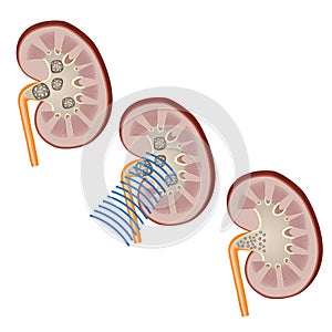 Shock waves to break a kidney stone.