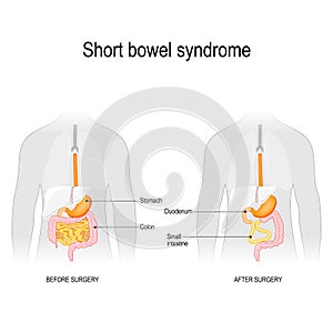 Krátky črevo. pred chirurgia a po chirurgia 