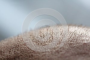 Short hair on a head close up. Scalp Man`s head. Baldness. Bald man. Problems with hair growth on the head