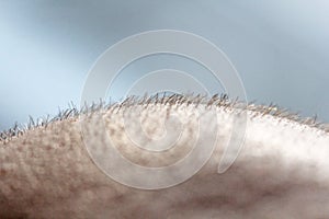 Short hair on a head close up. Scalp Man`s head. Baldness. Bald man. Problems with hair growth on the head