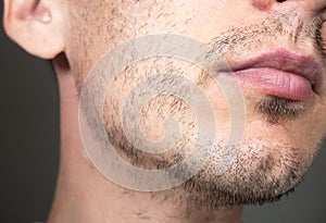 Short, sparse beard on mans face. Hair growth problems. Man with alopecia area in the beard. Unshaven bristles on the beard