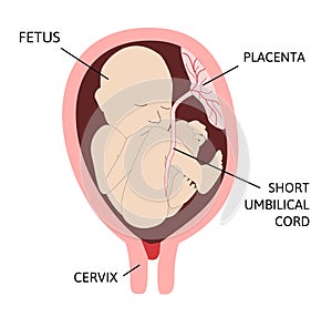 Short umbilical cord. measures less than normal length.