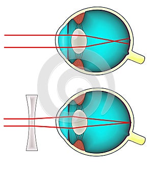 Shortsighted eye diagram