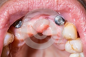 Shot of dental implant in the mouth of a patient with advanced p