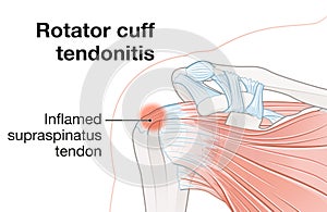 Shoulder anatomy. Rotator cuff tendonitis