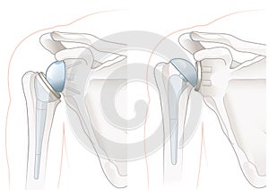 Shoulder arthroplasty. Shoulder replacement. Illustration