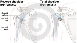 Shoulder arthroplasty. Shoulder replacement. Illustration