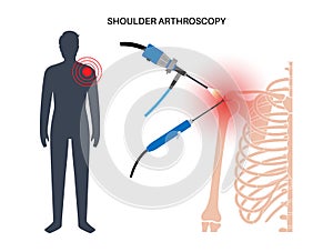 Shoulder arthroscopy poster