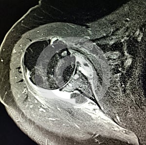 Shoulder burcitis glenohumeral osteoarthrosis