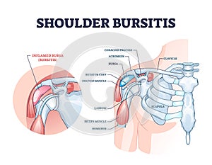 Shoulder bursitis as medical painful bursa inflammation outline diagram