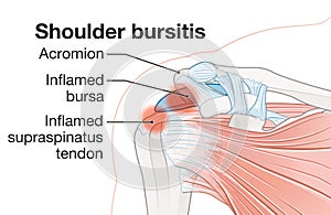 Shoulder bursitis. Inflamed bursa and supraspinatus tendon