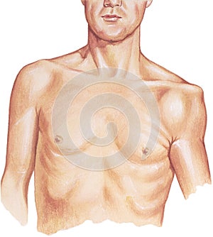 Shoulder - Dislocated