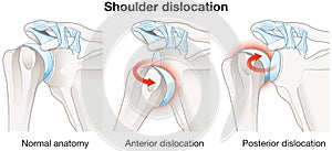 Shoulder dislocation. Anterior dislocation. Posterior dislocation. Labeled photo