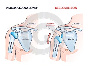 Shoulder dislocation and humerus bone trauma explanation outline diagram