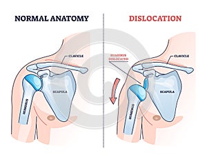 Shoulder dislocation and humerus bone trauma explanation outline diagram photo