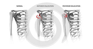 Shoulder dislocation options