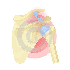 Shoulder dislocation, rupture of tendon, ligament, joints. Musculoskeletal trauma, injury.