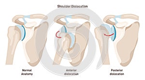 Shoulder dislocation types. Arm injury, upper arm bone pops out of the cup