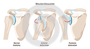 Shoulder dislocation types. Arm injury, upper arm bone pops out of the cup photo